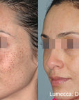 lumecca-before-after-spry-skin-and-wellness-preview