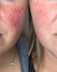 lumecca-before-after-spry-skin-and-wellness-preview