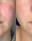 lumecca-before-after-spry-skin-and-wellness-preview