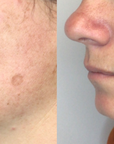 lumecca-before-after-spry-skin-and-wellness-preview