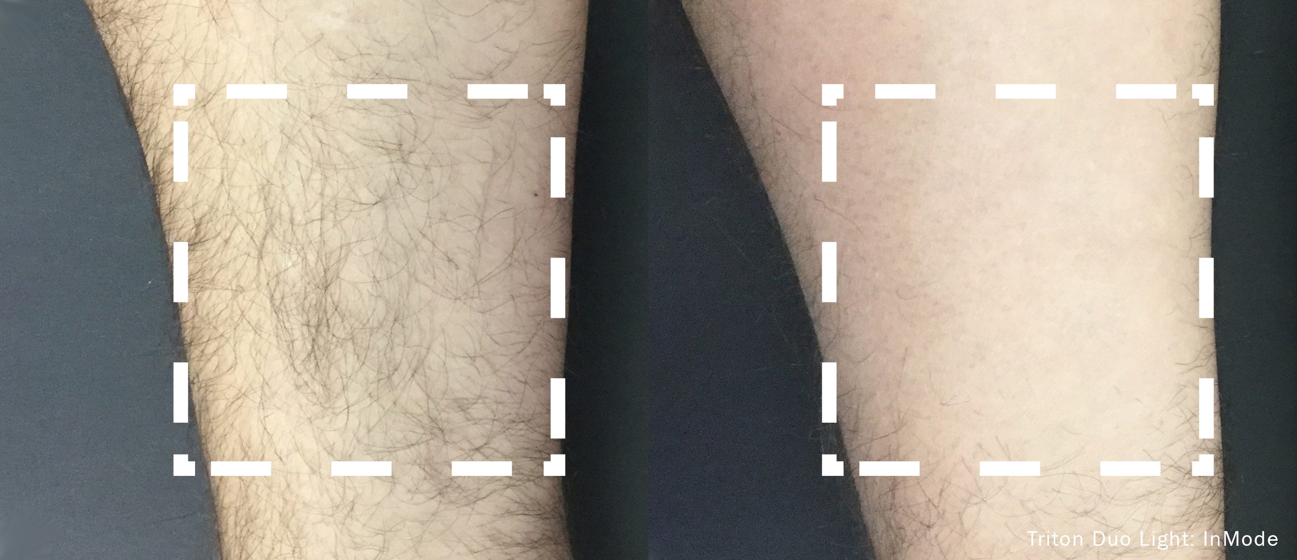 InMode-TritonDuoLight-Before_After