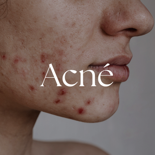 acne