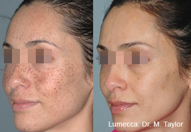 lumecca-before-after-spry-skin-and-wellness-preview
