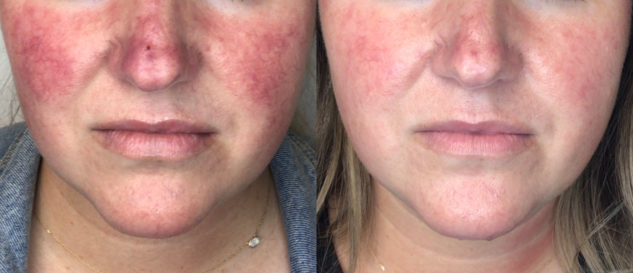 lumecca-before-after-spry-skin-and-wellness-preview