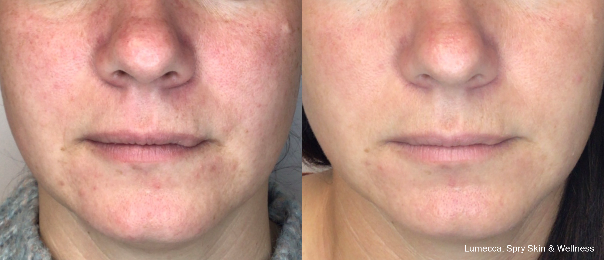 lumecca-before-after-spry-skin-and-wellness-preview