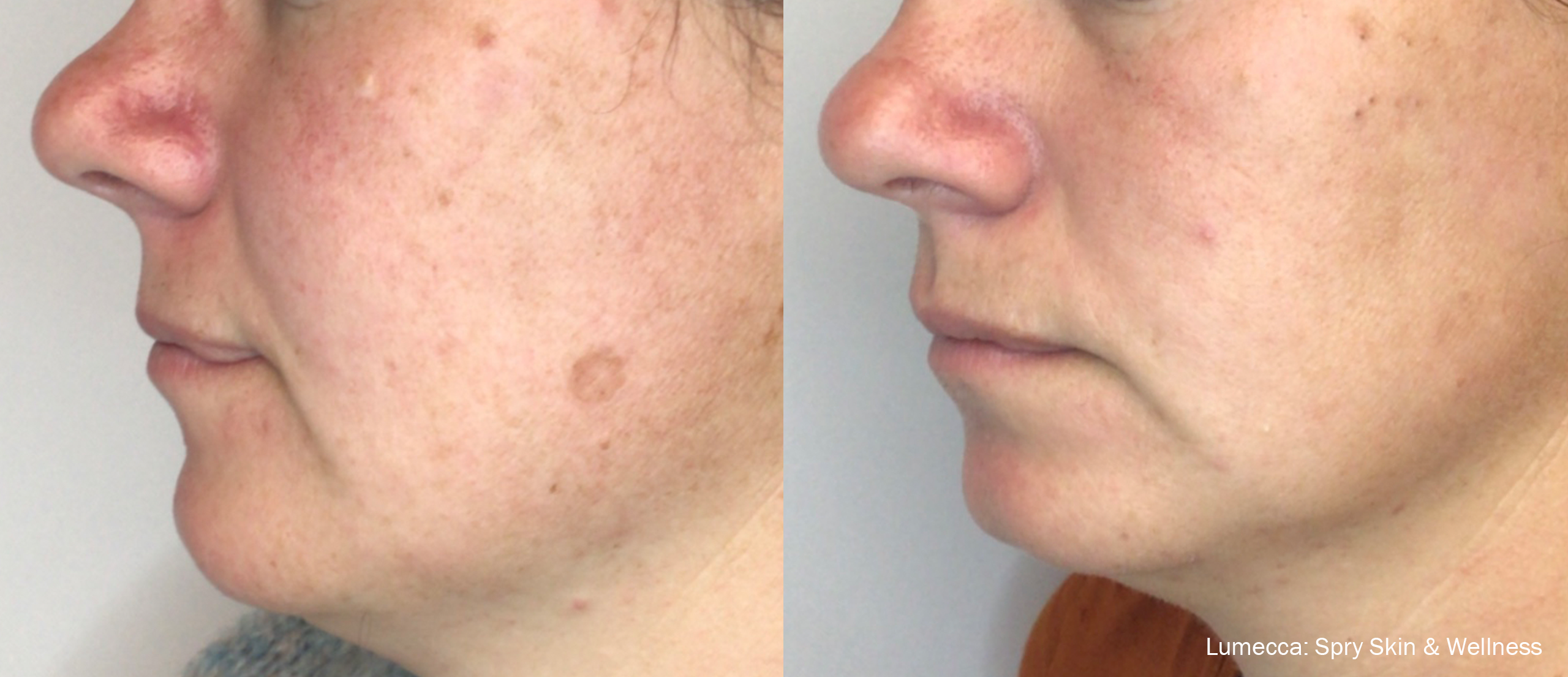 lumecca-before-after-spry-skin-and-wellness-preview