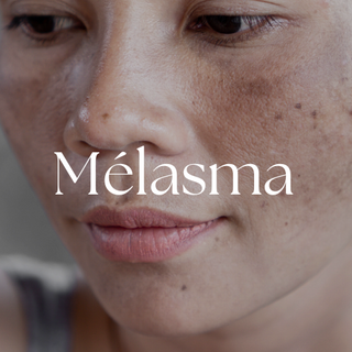melasma