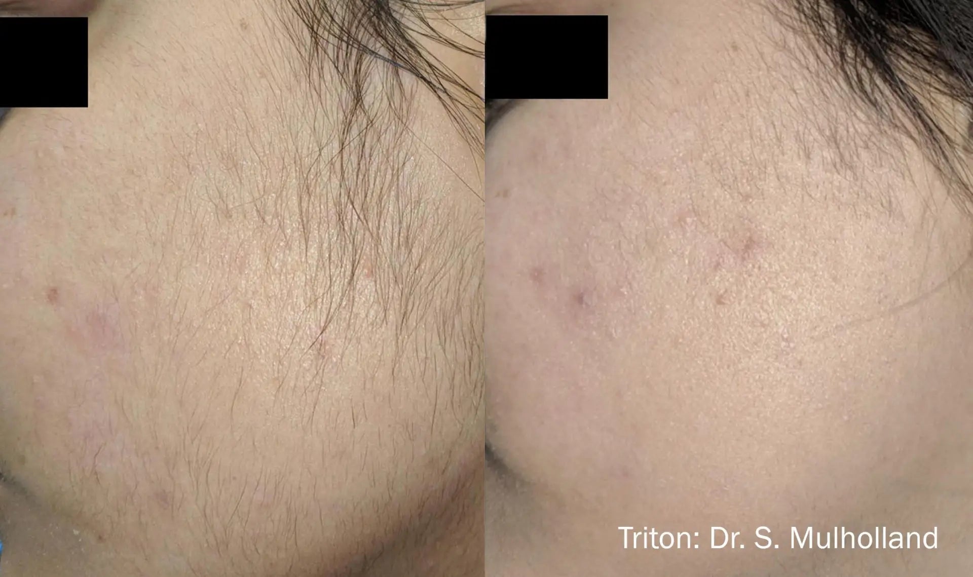 triton-before-after-dr-s-mullholland-preview