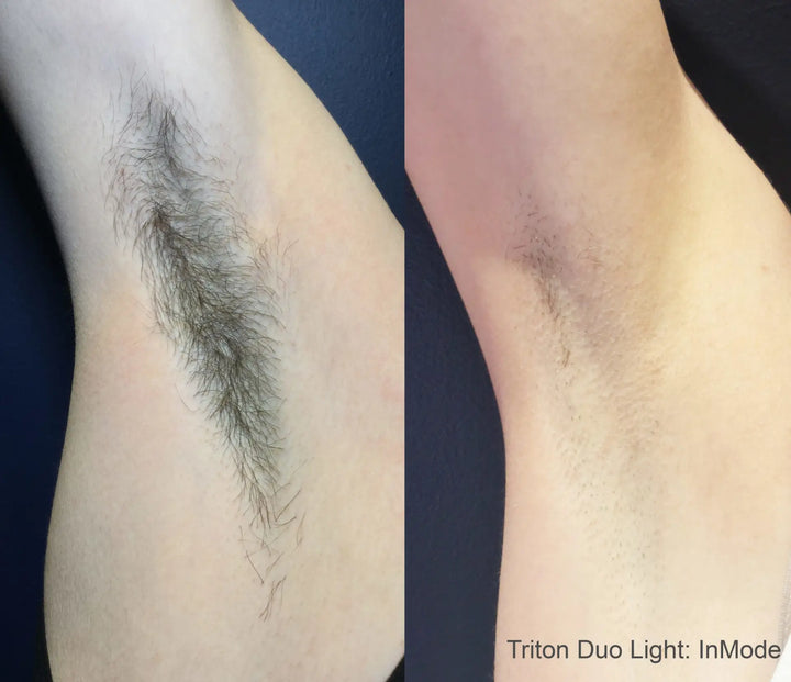 triton-before-after-inmode-preview